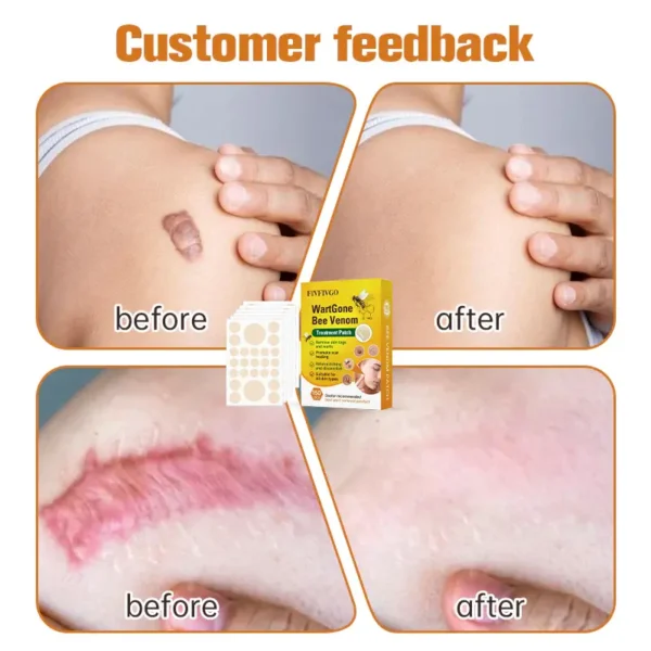 Fivfivgo™ WartGone Bee Venom Treatment Patch