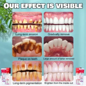 Unpree™ SP-6 Ultra+ Probiotic Whitening Toothpaste