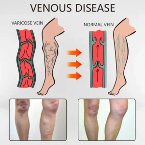 Ceoerty™ Varicose Veins Relief Oil