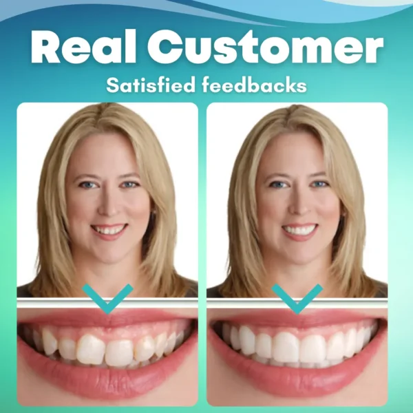 EzySmile™ SnapOn Silicone Veneers