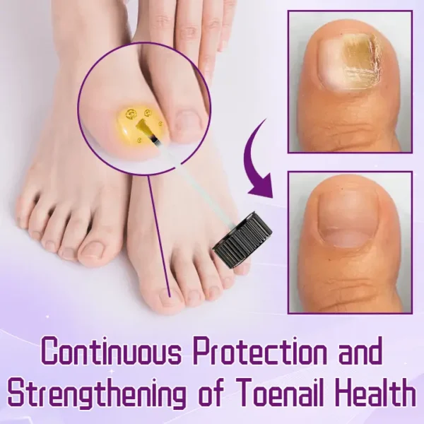 FLYCARE™ FungiGuard Bee Venom Toenail Serum