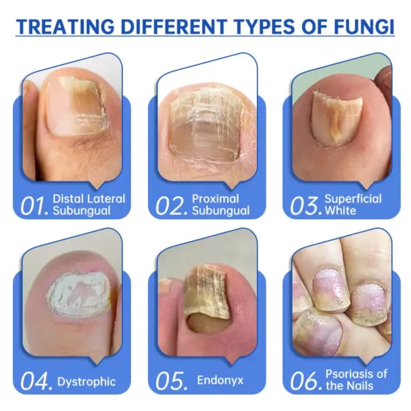 Furzero™ Advanced PureNail Fungus Laser Device