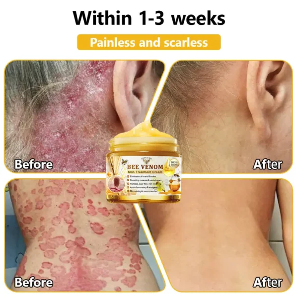 KINGURR™ Bee Venom Skin Treatment Cream