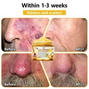 KINGURR™ Bee Venom Skin Treatment Cream