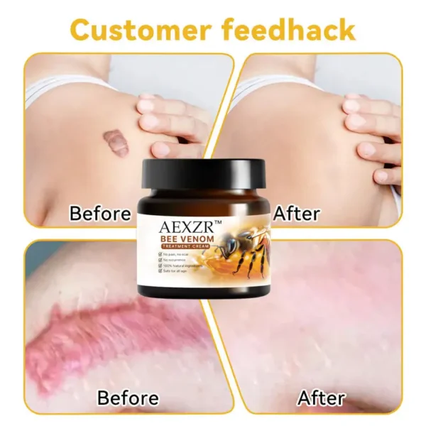 AEXZR™ Bee Venom Skin Treatment Cream