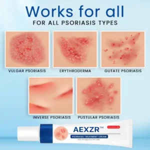 AEXZR™ Psoriasis Treatment Cream