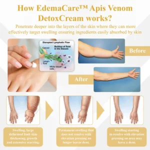 EdemaCare™ Apis Venom DetoxCream