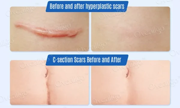 Oveallgo™ Silicone Anti-Scar Cream