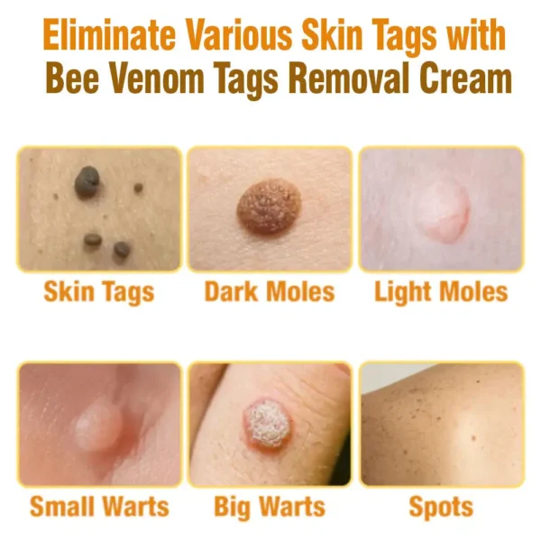 flysmus™ Bee Venom Tags Removal Cream