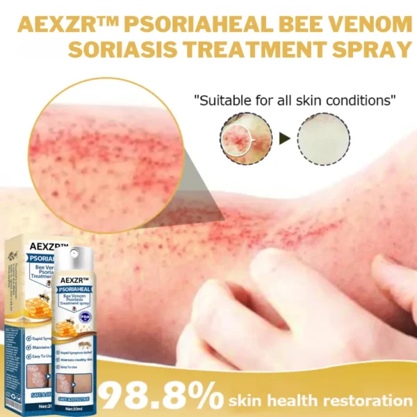 AEXZR™ PsoriaHeal Bee Venom Psoriasis Treatment Spray