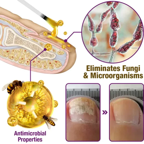 flysmus™ FungiFree Anti-fungal Bee Venom Nail Serum