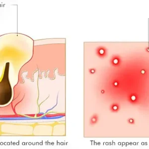 AEXZR™ Folliculitis Clearing Spray