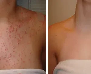 AEXZR™ Folliculitis Clearing Spray