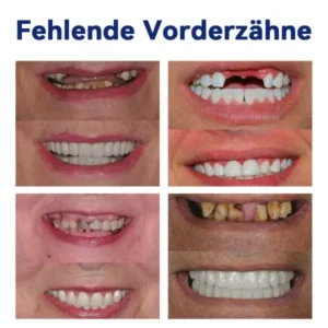 Bikenda ™ Silikon-Zahnprothesen- Reline-Set