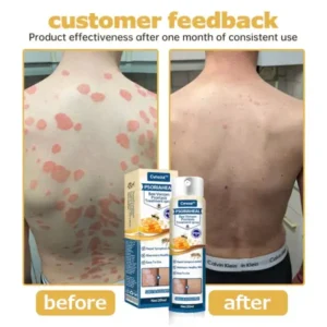 Cvreoz™ PsoriaHeal Bee Venom Psoriasis Treatment Spray