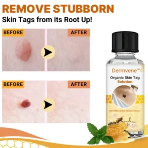 Dermvene™ Organic Skin Tag Solution