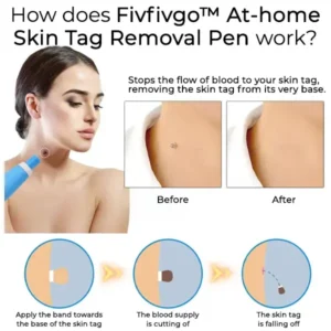 Fivfivgo™ At-Home Skin Tag Removal Pen