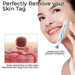 Fivfivgo™ At-Home Skin Tag Removal Pen