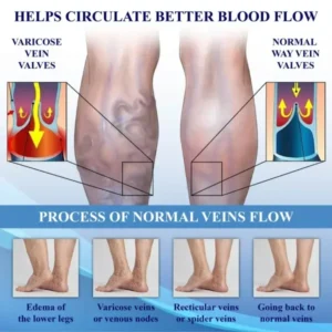 NerviEase™ Ultrasonic Circulation Band