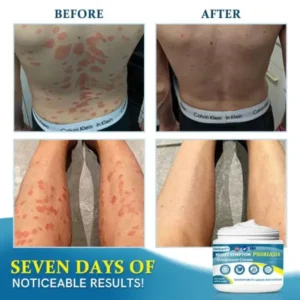 Ourlyard™ Advanced Multi-Symptom Psoriasis Treatment Cream