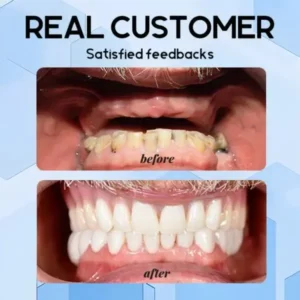 QIAWI – Holiday Smile Upgrade: The Best Dentures for Christmas & New Year!