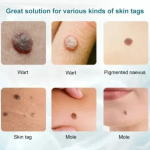 HZA™ Concentrated powerful skin tag removal cream